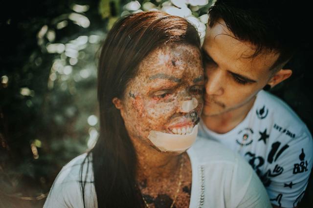 chang trai quyet yeu co gai bi huy hoai dung nhan, minh chung cho cau "tinh yeu luon ton tai" - 3