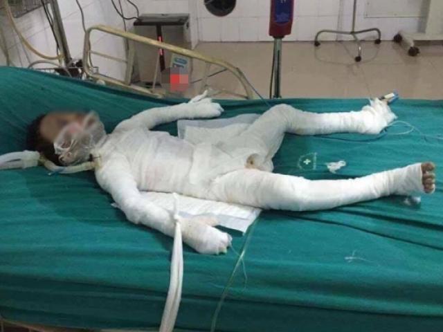 Hà Nội: Bé trai 6 tuổi bị bố dượng tẩm xăng đốt bỏng 98% cơ thể đã qua đời