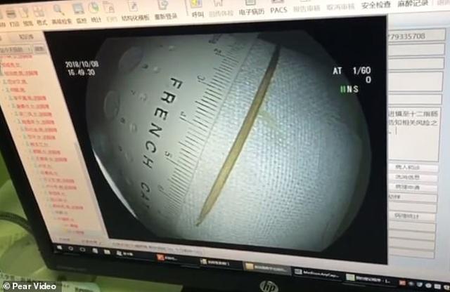 dau bung ca thang tuong bi da day, nguoi phu nu soc nang thay thu khong tuong nay trong nguoi - 3