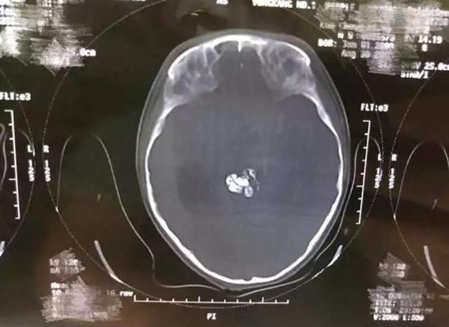 cau be 5 tuoi dau dau du doi, bac si ta hoa phat hien thu kinh di trong nao - 2