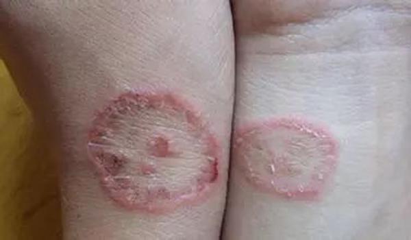 Hai cô gái bị nấm da chỉ vì có chung một sở thích không ít người có - 1