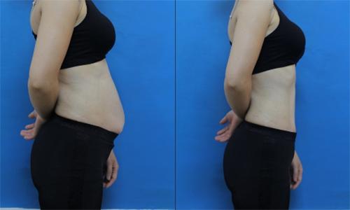 mo bung vai ngan cung bi danh bay voi noi nuoc gung than thanh nay - 7