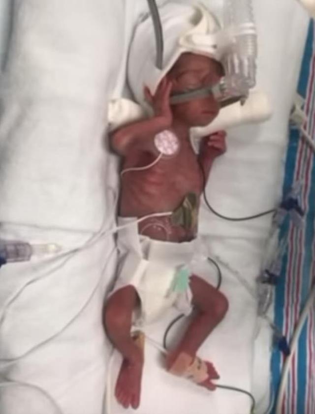 hanh trinh vuot "cua tu" cua be gai sinh non truoc 13 tuan, nang von ven 0,45kg - 1