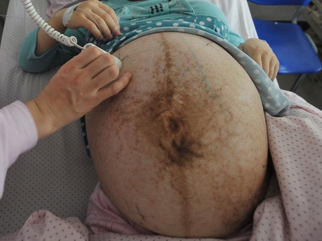 Bác sĩ nói siêu âm không có gì, mẹ vẫn khăng khăng đang mang bầu 6 con suốt 4 năm