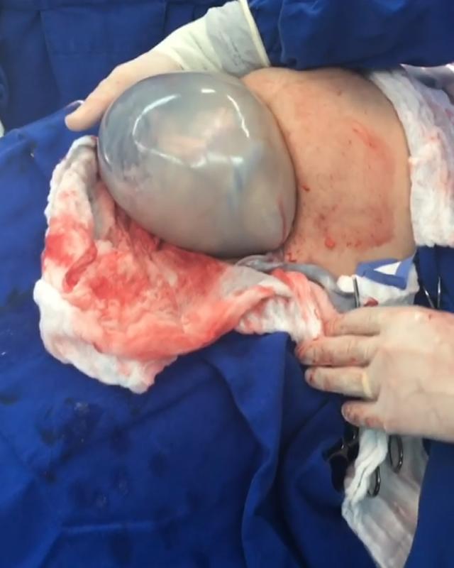 khoanh khac ky dieu: em be chui dau ra khoi bung me nhung boc oi van con nguyen - 1