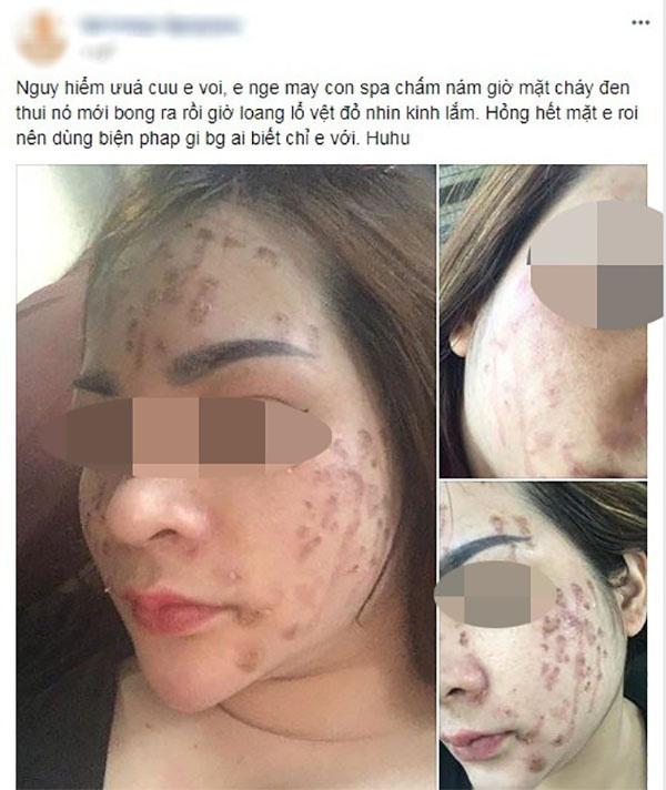 cham nam bang axit: phuong phap khien chi em dang xinh dep tro thanh tham hoa xau xi - 1