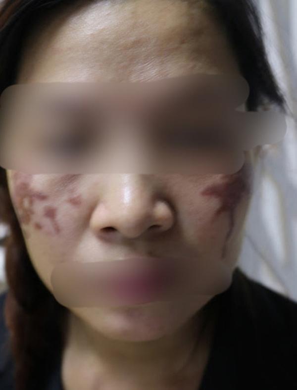 cham nam bang axit: phuong phap khien chi em dang xinh dep tro thanh tham hoa xau xi - 3