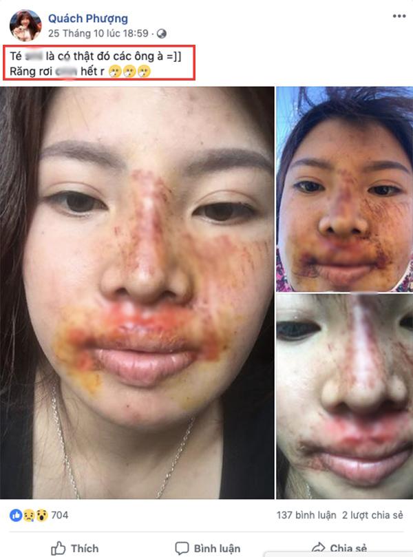 bi che xuong sac hau dao keo, phuong "thi no" khoe anh nhan sac thay doi chong mat - 5