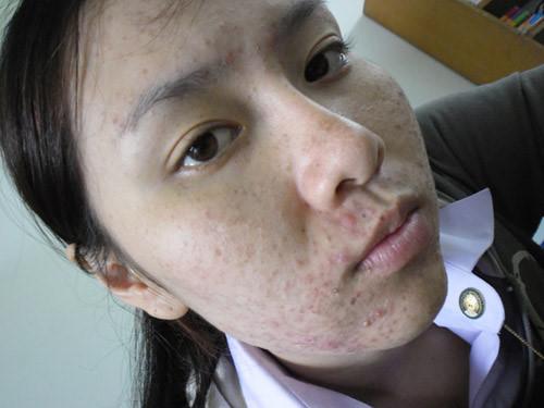 mun nhieu nhu no hoa hay tham den nhu vung com chay cung nhan min voi 3 cach duoi day - 1