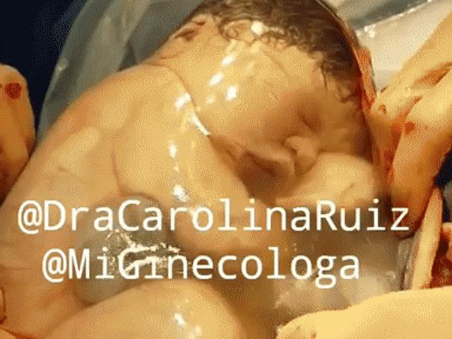 Em bé nằm trong túi ối ngủ quên đời, bác sĩ mổ xong phải gọi mãi mới dậy