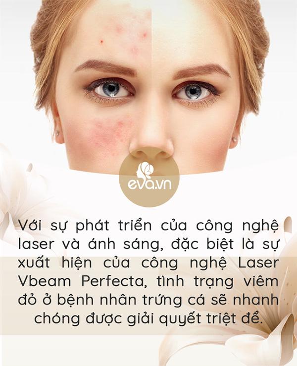 3 ngày nữa Noel, 7 ngày nữa tết Tây, làm sao trị mụn trứng cá nhanh mà còn an toàn?