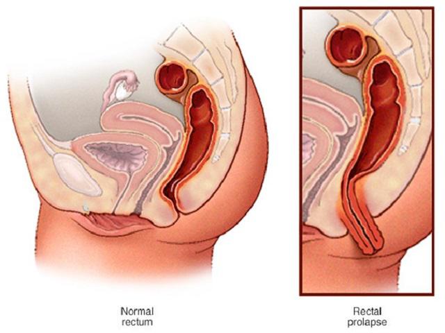 Sa dạ con sau sinh nguy hiểm như thế nào? - 3