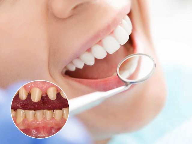 Những điều bạn nhất định phải biết trước khi tiến hành bọc răng sứ