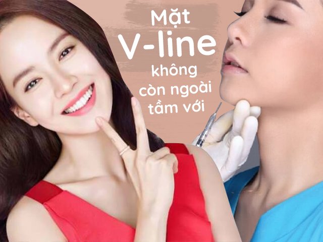 Thẩm mỹ tạo mặt V-line và những điều chị em chưa biết