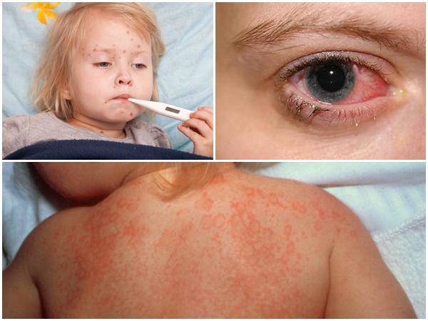 Những biến chứng nguy hiểm có thể xảy ra khi trẻ bị sốt siêu vi - Tư vấn  sức khỏe trẻ em