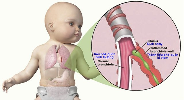 Trẻ sơ sinh thở khò khè như có đờm phải làm sao? - 1