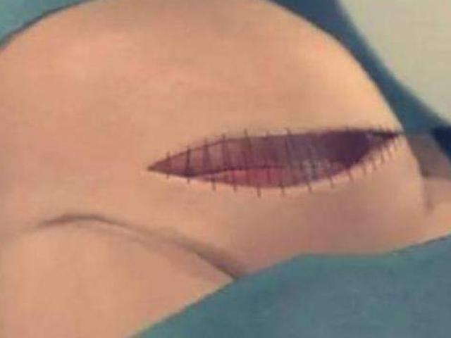 Thai nên được đưa ra 15 phút sau sinh mổ, bác sĩ: liên quan số phận đứa trẻ thứ hai