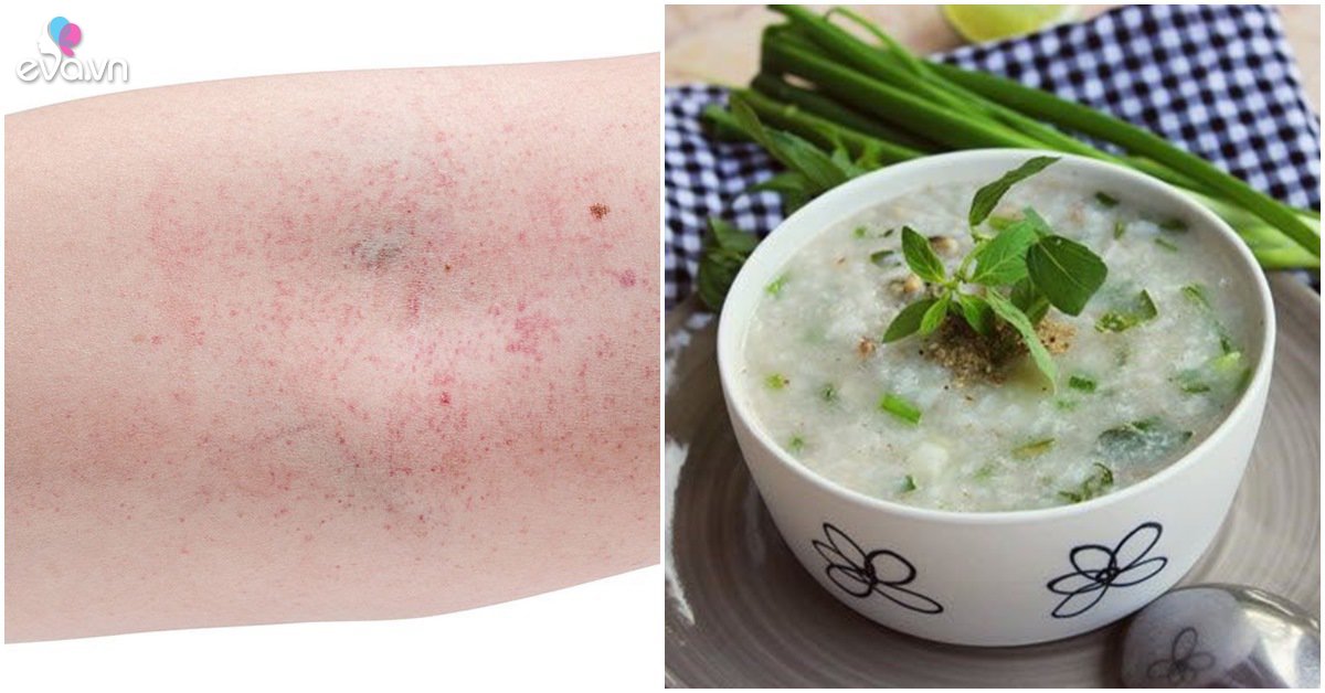 Sốt xuất huyết nên ăn gì để bệnh nhanh khỏi, tránh biến chứng