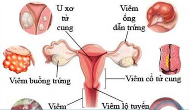 khi hu nhieu, ngua vung kin - dau hieu ung thu co tu cung chi em thuong bo qua - 1