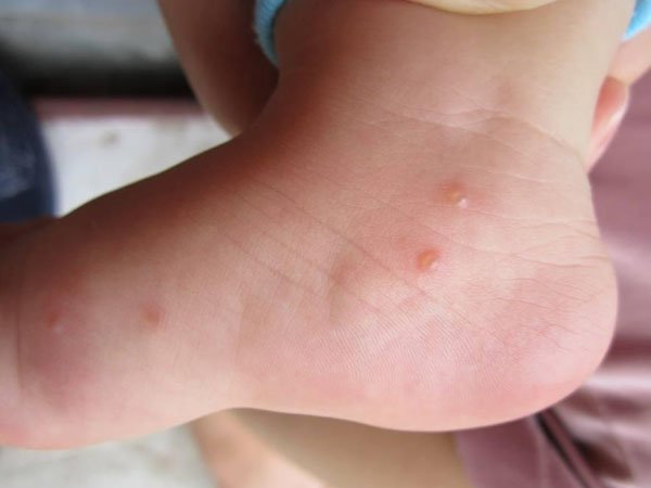 Nổi mụn nước khắp người: Nguyên nhân và cách điều trị - 1