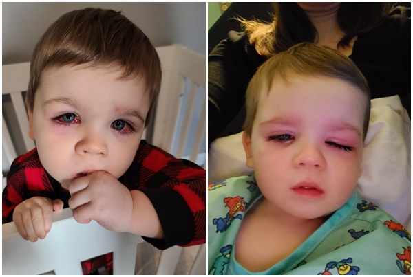 Bé trai mắt đỏ như máu, suýt mù vì thứ nhiều cha mẹ cho con dùng khi tắm - 3
