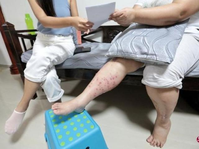 Đi thẩm mỹ viện tẩy lông chân, người phụ nữ tá hỏa khi chân nổi hàng trăm mụn mủ
