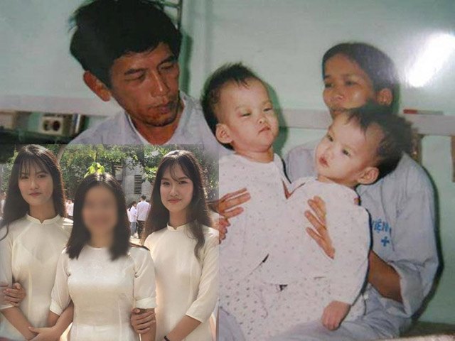 Cặp song sinh dính liền Cúc-An sau 17 năm tách rời: Cả hai vào đại học, tập sống xa nhau