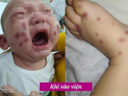 Sốt 1 ngày đi khám, bé trai 6 tháng tuổi phát hiện mắc bệnh chưa từng có tại Việt Nam