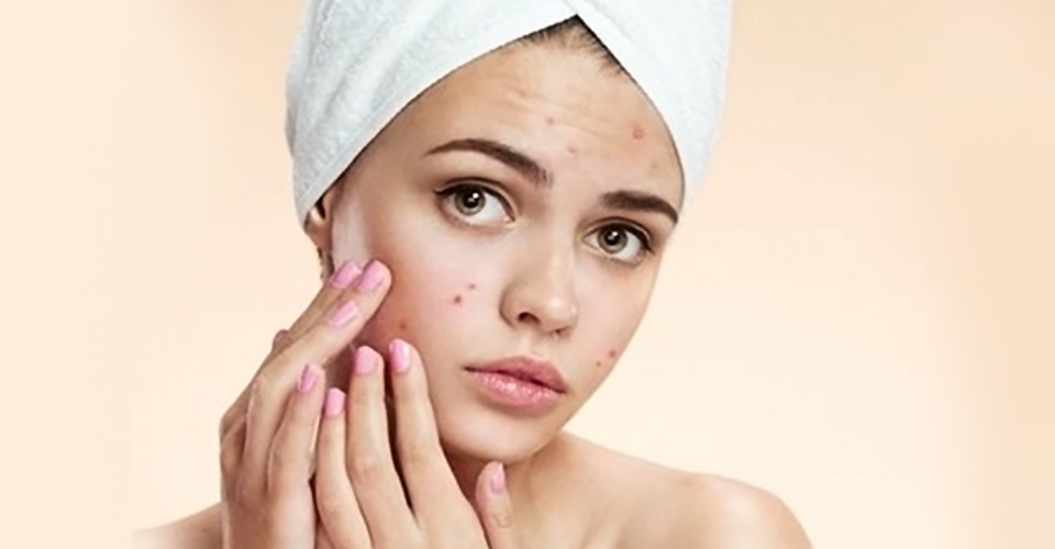 Ăn gì hết mụn? Chế độ ăn uống khi da bị mụn - 1