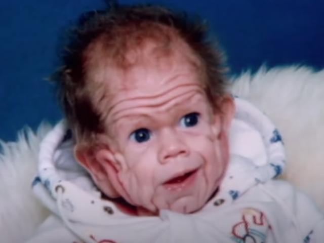 Hình ảnh hiện tại của bé trai sinh ra với làn da nhăn nheo, duy nhất trên thế giới