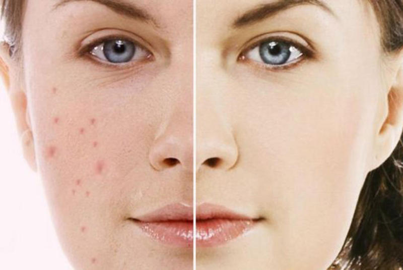 Cách trị thâm mụn đơn giản, hiệu quả tại nhà