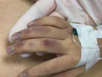 Vụ bé gái 6 tuổi tử vong: Vì sao người cha bị khởi tố về Tội cố ý gây thương tích? 