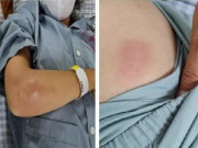 Sưng đau “vòng một”, cô gái Tuyên Quang đi cấp cứu phát hiện “vi khuẩn ăn thịt người” tấn công