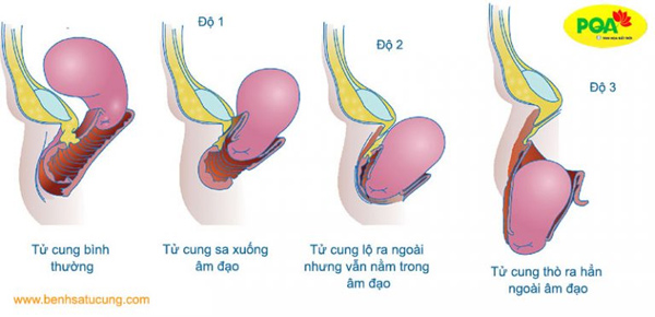 Hiện tượng sa dạ con nguy hiểm như thế nào? - 1