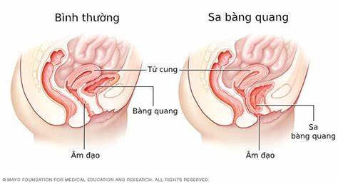 Hiện tượng sa dạ con nguy hiểm như thế nào? - 2