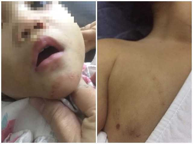 Bé gái 16 tháng tuổi nghi bị bạo hành, cơ thể có nhiều vết bầm và vết cắn