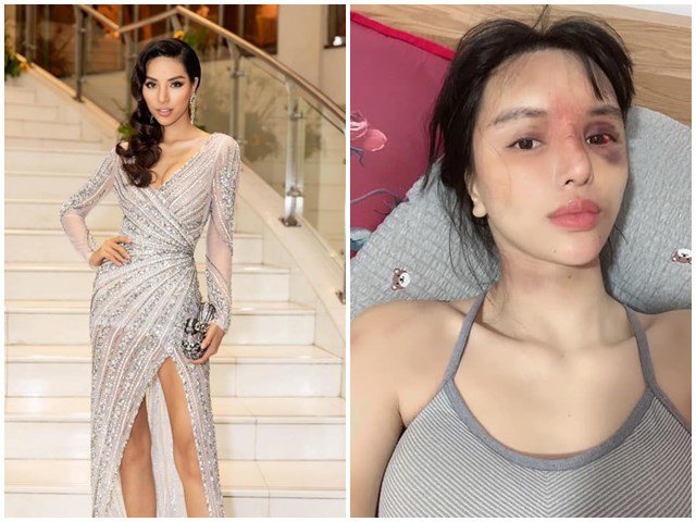 Siêu mẫu Việt nổi tiếng đăng ảnh thương tích rợn người sau khi bất ngờ thông báo mới sinh con