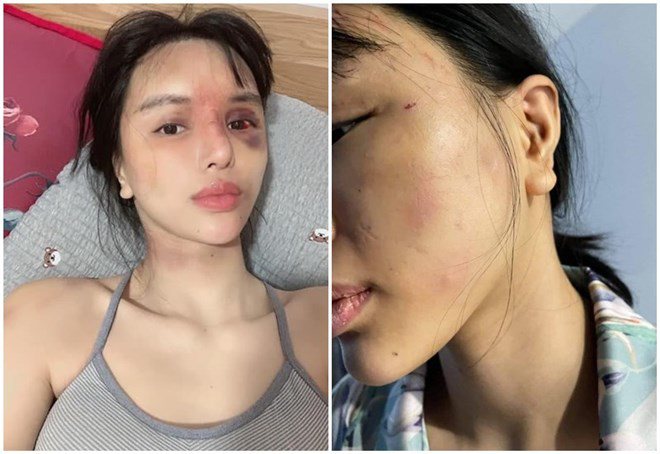 Siêu mẫu Việt nổi tiếng đăng ảnh thương tích rợn người sau khi bất ngờ thông báo mới sinh con - 3