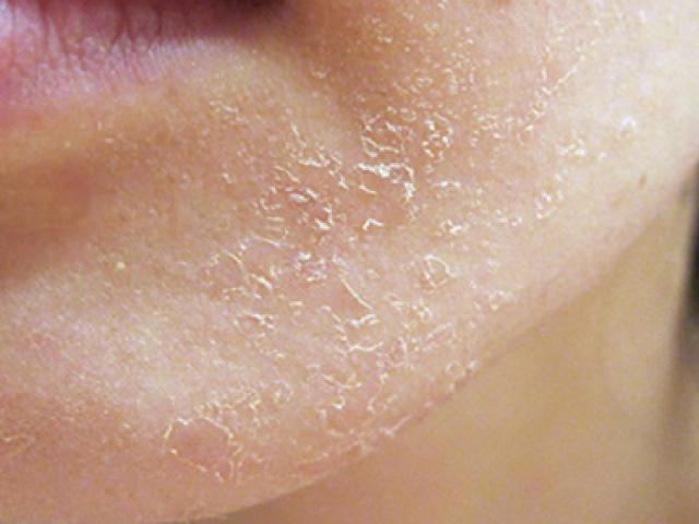 Mùa lạnh con phải vào viện vì da nứt nẻ, thủ phạm là cách cho trẻ ăn mẹ hay mắc