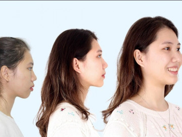 Niềng răng có làm thay đổi khuôn mặt đẹp hơn không?