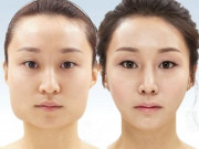 Bạn cần chuẩn bị những gì khi quyết định phẫu thuật đường viền khuôn mặt?