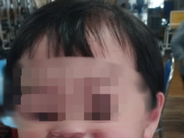 Bé 2 tuổi méo miệng, liệt dây thần kinh số 7 do trời lạnh